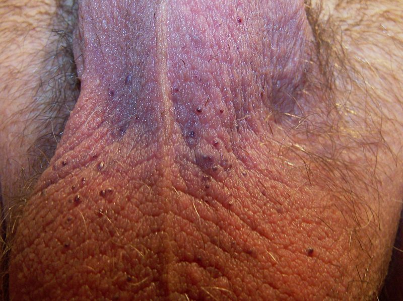 File:Angiokeratoma of the Scrotum 3.jpg