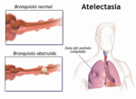 Miniatura para Atelectotrauma