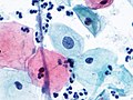 Atipia de células escamosas (ASCUS, ASC) (9392112465).jpg