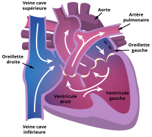 Schéma d’un cœur présentant une atrésie tricuspide.