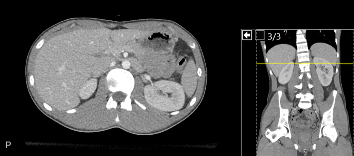 CT of a normal abdomen and pelvis, axial plane 87.png