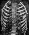 Fig. 16. — Démonstration photographique de l'aspect doliforme de thorax.