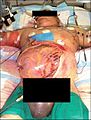 Decompression laparotomy for abdominal compartment syndrome.jpg