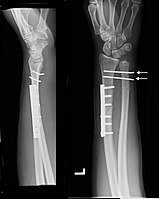 Galeazzi fracture after surgical fixation