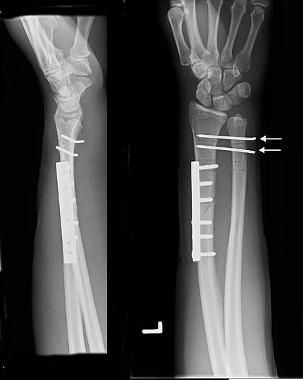 Перелом руки лучевая кость. Перелом Галеацци остеосинтез. Перелом галеоации остеосинтез. Оскольчатый перелом лучевой кости. Сгибательный перелом лучевой кости.