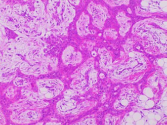 Histopathology of chondroid syringoma Histopathology of chondroid syringoma.jpg