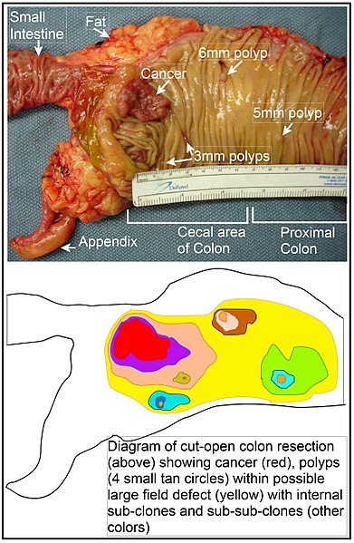Fișier:Image of resected colon segment with cancer & 4 nearby polyps plus schematic of field defects with sub-clones.jpg