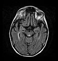 Axial MRI FLAIR image showing hyperintense signal in the periaqueductal gray matter and tectum of the dorsal midbrain.