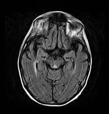 Axial MRI FLAIR image showing hyperintense signal in the periaqueductal gray matter and tectum of the dorsal midbrain.