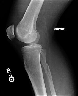 Maisonneuve fracture Medical condition