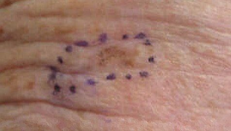 Melanoma in situ, right forehead marked for biopsy (Original Post: Shared in Melanoma)