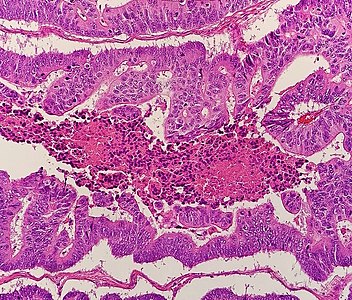 colorectal cancer histology papilloma virus genitale sintomi