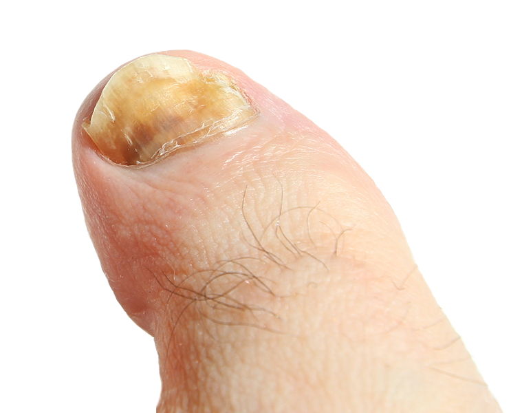 File:Mycose de l'ongle du gros orteil gauche - 1.jpg