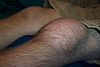 Swelling caused by prepatellar bursitis