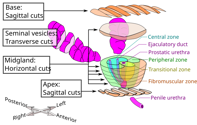 File:Prostate cutting.svg