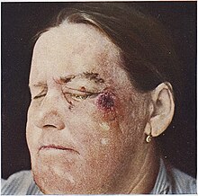 Anthrax skin lesion on the face Riehl Zumbusch Tafel IV (2).jpg