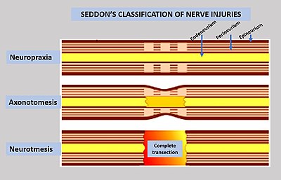 Sedon's classification of nerve injuries.jpg