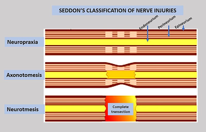 File:Sedon's classification of nerve injuries.jpg