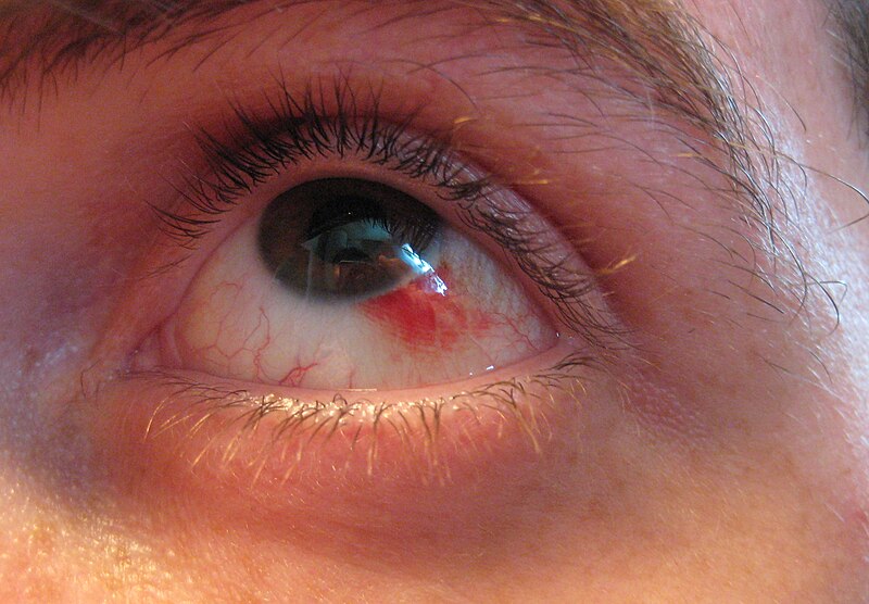 File:Subconjunctival hemorrhage 02.jpg