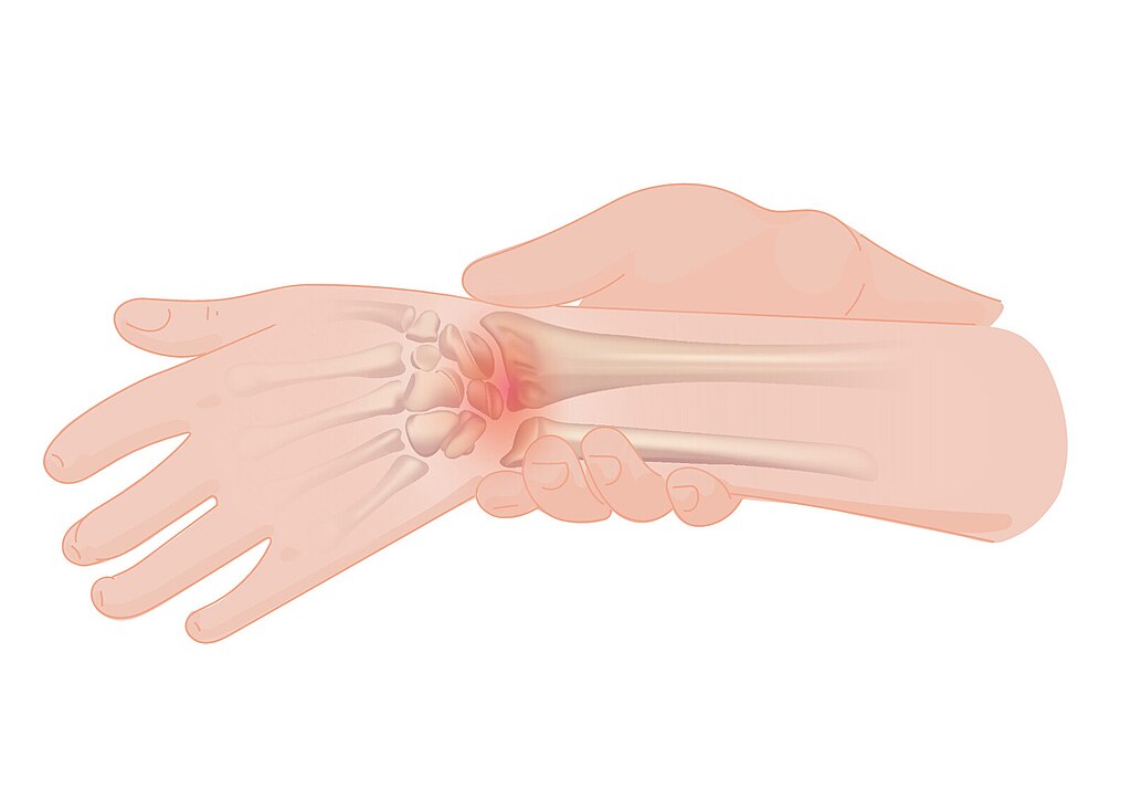  Wrist pain 