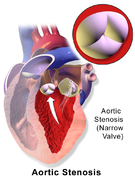 aortic stenosis