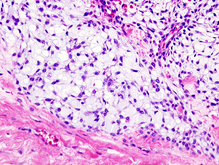 Chondrosarcoma (2).jpg