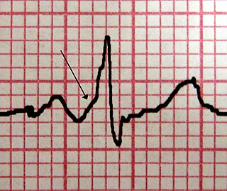 Wolff–Parkinson–White syndrome Medical condition