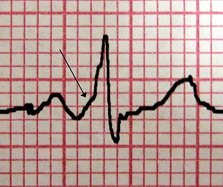 A characteristic "delta wave" (arrow) seen in a person with Wolff–Parkinson–White syndrome. Note the short PR interval.