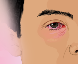 Depiction of a child with a red eye (cropped).png