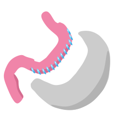 Gastric sleeve icon.svg