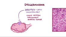 ملف:Germ cell ovarian cancer.webm