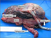 Gross pathology of a uterus which has been opened to show a placental abruption, with a hematoma separating the placenta from the uterus. Gross pathology of placental abruption.jpg