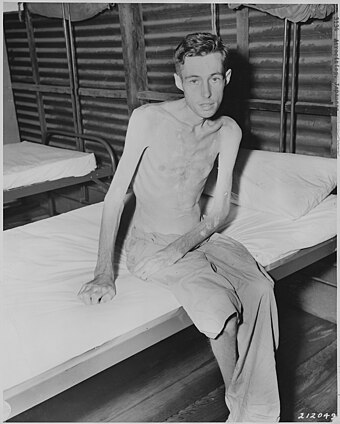 Prisoner of war exhibiting muscle loss as a result of malnutrition.