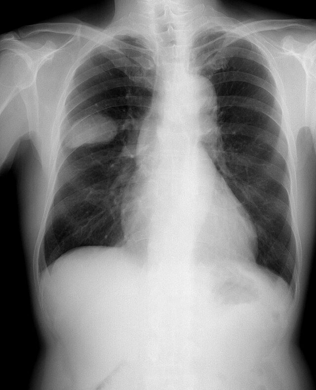 Cirugía de columna lumbar - Serie—Procedimiento: MedlinePlus enciclopedia  médica