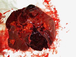 <span class="mw-page-title-main">Splenic injury</span> Medical condition