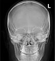 Paranasal sinuses radiograph (occipitofrontal)