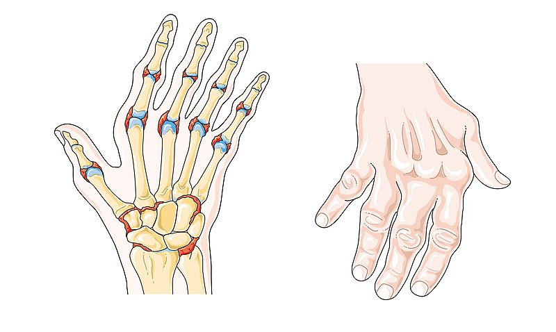 File:Rheumatoid arthritis -- Smart-Servier (cropped).jpg