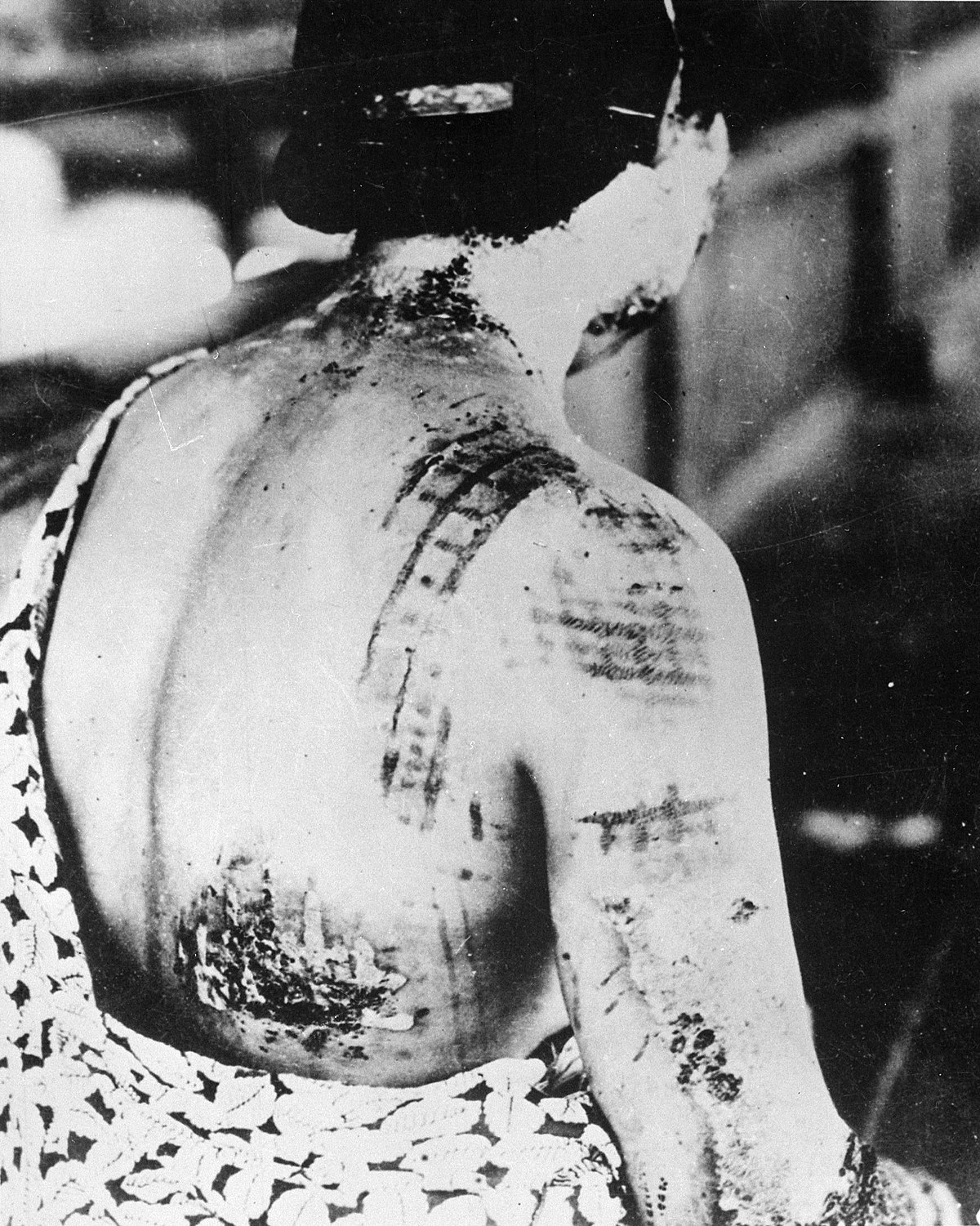 The patient's skin is burned in a pattern corresponding to the dark portions of a kimono - NARA - 519686.jpg