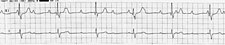 EKG - AV blok III. stupně