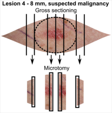 Gewebeselektion aus Hautentfernung mit 4-8 mm Verdacht auf maligne Läsion.png