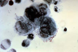 <span class="mw-page-title-main">Tzanck test</span> Skin test for chickenpox and herpes