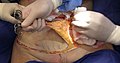 Skin and fat removal during abdominoplasty