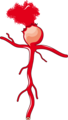 Saccular Aneurysm 2