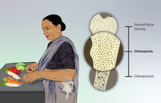 Osteopenia exists on a spectrum of normal to dangerously low bone density (osteoporosis). Depiction of a woman suffering from Osteopenia.png
