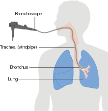 Diagram of a machine attached to a tube running down a person's mouth and into their trachea and bronchi