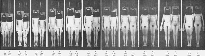 Your Whole Baby on X: Does your doctor say your child has phimosis? Sex  characteristics change in form and function as a child grows and matures.  The natural, non-retractable state of a