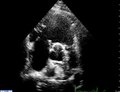 File:Echocardiographic-imaging-of-tricuspid-and-pulmonary-valve-abnormalities-in-primary-ovarian-1476-7120-8-37-S2.ogv