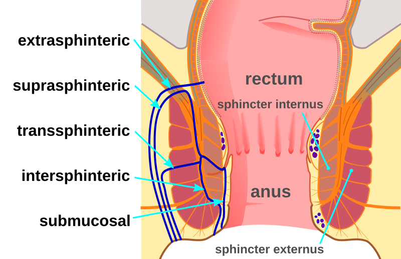 perianal fistula crohns