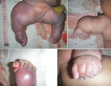 An infant with Hydrops-ectopic calcification-moth-eaten skeletal dysplasia showing shortened limbs. Greenberg Skeletal Dysplasia first reported case in the Democratic Republic of Congo P04.png