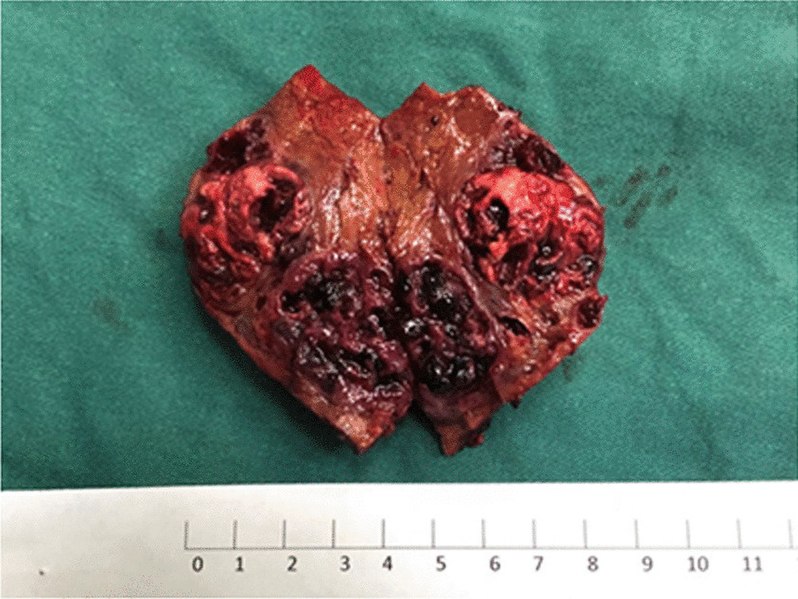 File:Gross specimen of liver angiosarcoma.jpg